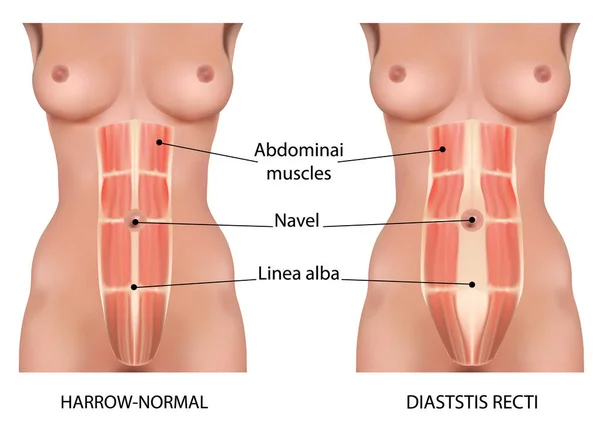 Diastasis rekti kası karın ayrımı olarak da bilinir.