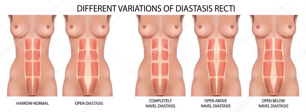 Diastasis recti also known as abdominal separation.