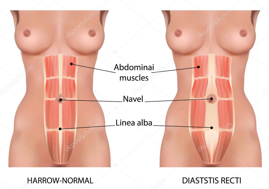 Diastasis recti also known as abdominal separation.