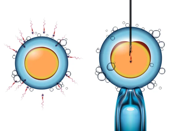 Tipos de fertilização artificial do óvulo por esperma —  Vetores de Stock