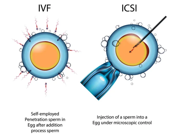 Druhy umělého oplodňování vajíček spermatem Eco und ICSI — Stockový vektor