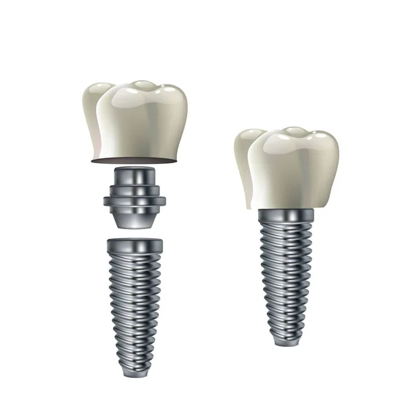 Ilustración vectorial de implantes dentales - póster de infografía médica de dientes humantes — Archivo Imágenes Vectoriales