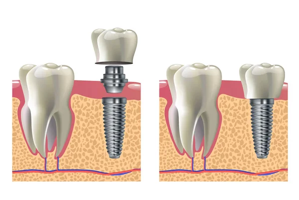 Ilustração do vetor do implante dentário - poster infográfico médico dos dentes humantes —  Vetores de Stock