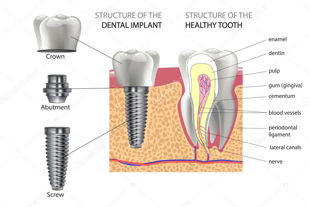 Realistic healthy tooth and structure, dental implant with all parts: crown, abutment, screw.