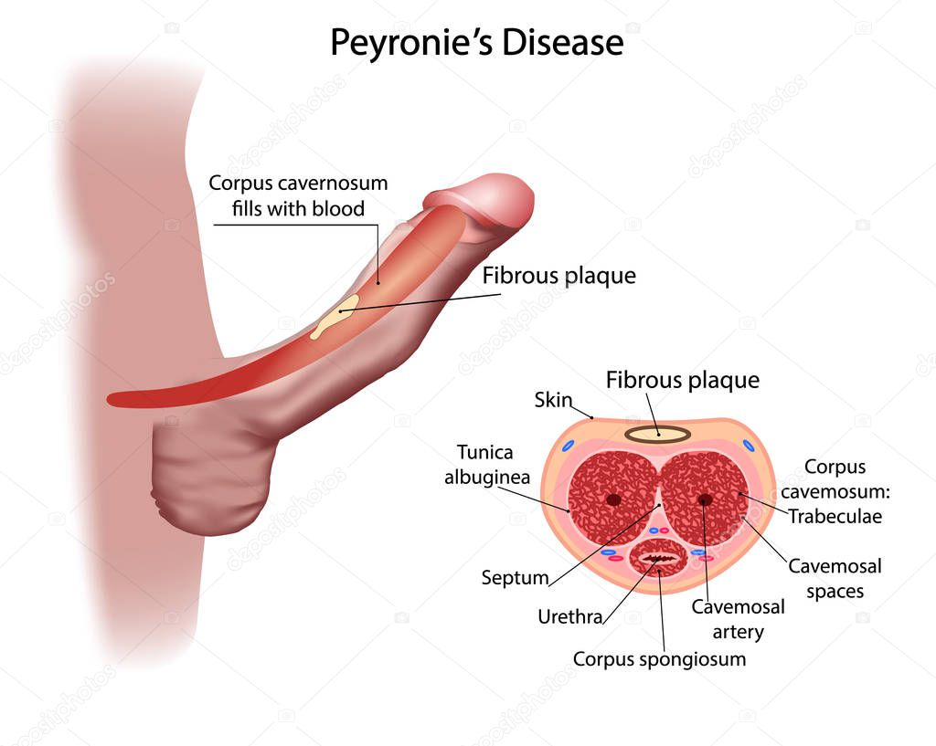 Peyronies disease, with formation of a fibrous plaque and penis deviation