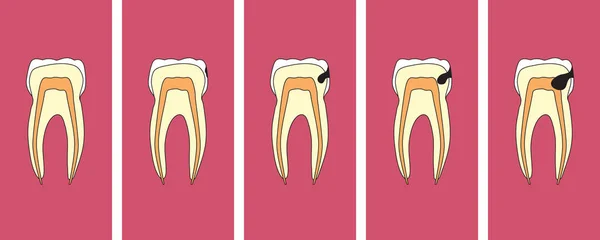 Karies Auf Dem Backenzahn Karikatur Vektorillustration — Stockvektor