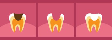 Diş çürümesi ve tedavisi. Diş Hekimliği Vektör illüstrasyon.