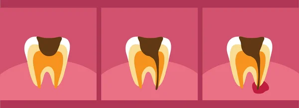 Karies Und Zahnfleischentzündung Zahnmedizin Vektor Illustration — Stockvektor