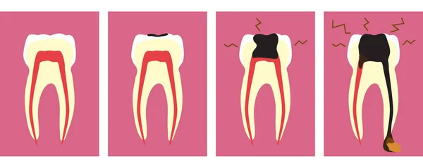 Tiefe Karies Und Entzündungen Des Zahnfleisches Zahnmedizin Vektor Illustration — Stockvektor