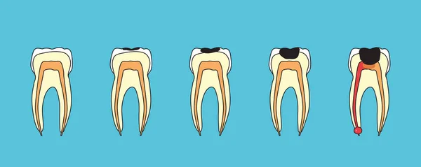 Diepe Cariës Tand Ontsteking Een Blauwe Achtergrond Tandheelkunde Vector Illustratie — Stockvector