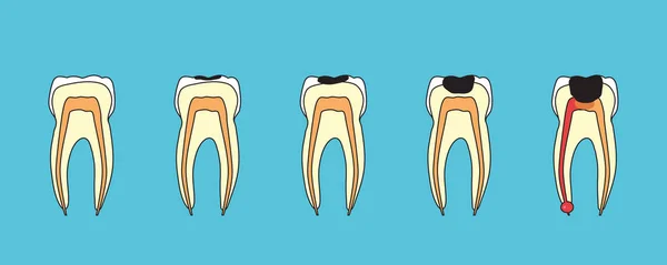 Глубокий Кариес Воспаление Зубов Синем Фоне Векторная Иллюстрация — стоковый вектор