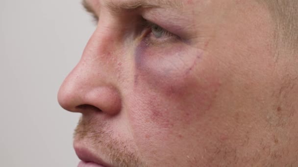 Man with bruise uner eye — Stock Video