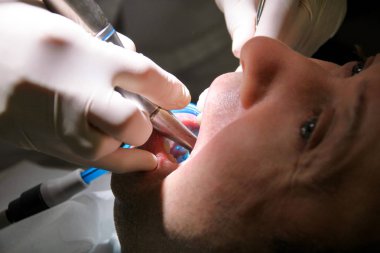 Diş diş parlatma. Diş temizliği, diş temizliği. Dişçi Diş Kliniği ve office iş araçları ayna, yumuşak diş fırça ve emme borusu ağzına hasta diş parlatma.