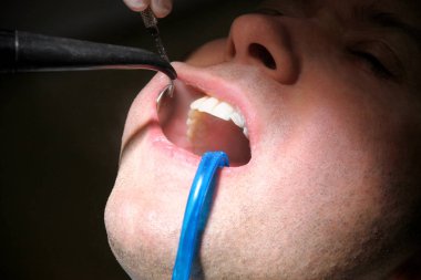 Diş durulama için diş araç. Diş temizliği, diş temizliği. Dişçi Diş Kliniği ve office iş yerinde ayna ile hasta diş temizleme aracı sprey ve emme tüpü ağzına durulama.