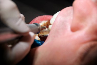 Diş işaretleyiniz. Diş araçları sonda, ayna ve emme borusu ağzında diş check-up. Diş hekimi hastanın diş dişçi Kliniği ve office incelenmesi. Diş Hekimliği ağız hijyeni. Diş hekimi kavramı.