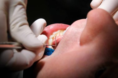 Diş işaretleyiniz. Diş araçları sonda, ayna ve emme borusu ağzında diş check-up. Diş hekimi hastanın diş dişçi Kliniği ve office incelenmesi. Diş Hekimliği ağız hijyeni. Diş hekimi kavramı.