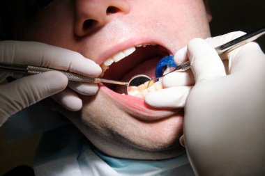 Diş işaretleyiniz. Diş araçları sonda, ayna ve emme borusu ağzında diş check-up. Diş hekimi hastanın diş dişçi Kliniği ve office incelenmesi. Diş Hekimliği ağız hijyeni. Diş hekimi kavramı.