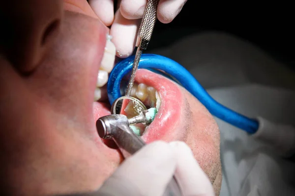 Zubní Zubní Leštění Čištění Hygiena Zubů Zubař Práci Své Zubaře — Stock fotografie