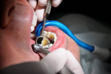 Diş diş parlatma. Diş temizliği, diş temizliği. Dişçi Diş Kliniği ve office iş araçları ayna, yumuşak diş fırça ve emme borusu ağzına hasta diş parlatma.