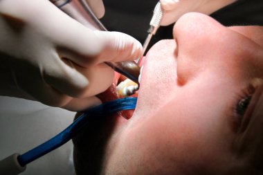 Diş diş parlatma. Diş temizliği, diş temizliği. Dişçi Diş Kliniği ve office iş araçları ayna, yumuşak diş fırça ve emme borusu ağzına hasta diş parlatma.