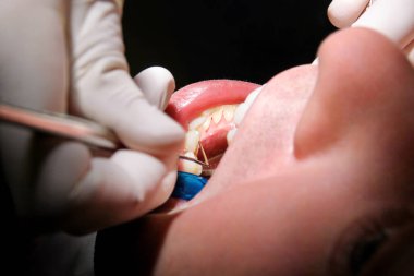 Diş işaretleyiniz. Diş araçları sonda, ayna ve emme borusu ağzında diş check-up. Diş hekimi hastanın diş dişçi Kliniği ve office incelenmesi. Diş Hekimliği ağız hijyeni. Diş hekimi kavramı.