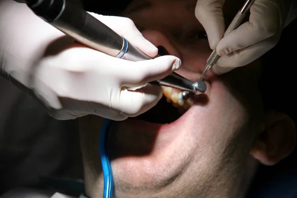 Tandheelkundige Tand Polijsten Gebit Reinigen Mondhygiëne Tandarts Het Werk Zijn — Stockfoto