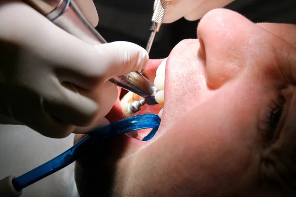 Dental tooth polishing. Teeth cleaning, dental hygiene. Dentist at work in his dentist clinic and office is polishing of patient teeth with tools mirror, soft dental brush and suction tube in mouth.