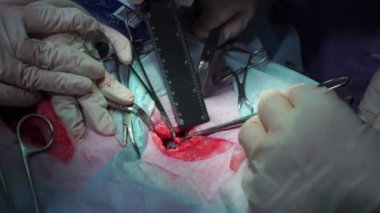 Ameliyat. Doktorlar elleri kesilmiş bir cetvel ile ölçmek