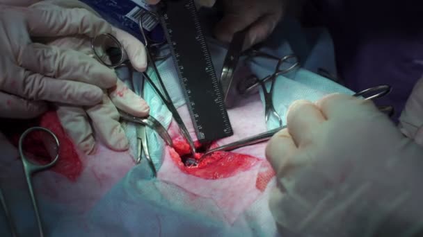 Chirurgia. W ręce lekarzy zmierzyć cięcia z linijką — Wideo stockowe