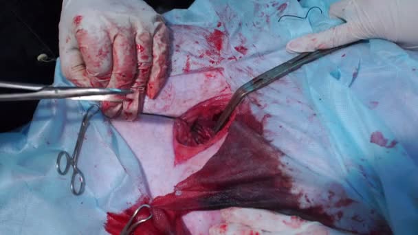 De handen van de artsen knippen de slagader met een schaar — Stockvideo