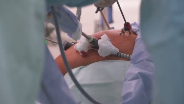 Surgeon performs an endoscopic operation on the organs of the abdominal cavity — Stock Video
