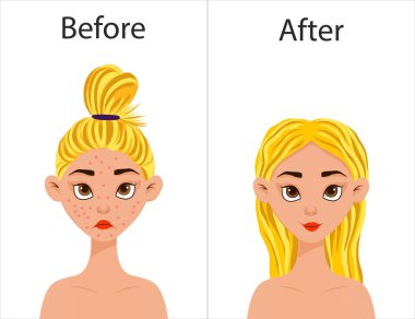 Sivilce tedavisi öncesi ve sonrası kız. Çizgi film tarzı. Vektör illüstrasyonu