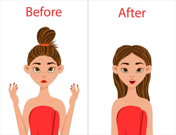 Chica Antes Después Del Tratamiento Del Acné Estilo Dibujos Animados — Vector de stock