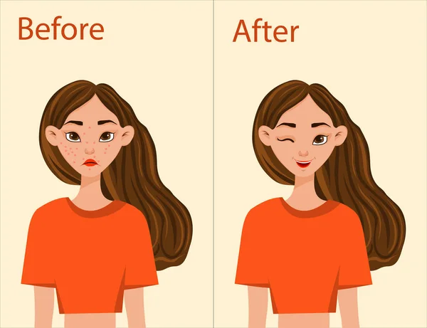 Chica Antes Después Del Tratamiento Del Acné Estilo Dibujos Animados — Vector de stock