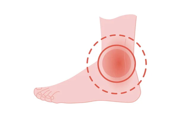 Douloureux pied jambe concept avec douleur talon rouge cercle dessin animé plat dessin vectoriel illustration sur fond blanc — Image vectorielle