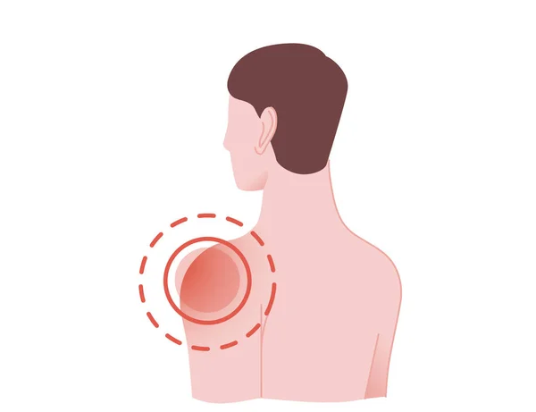 Concepto de hombro doloroso con círculos de dolor humano en la parte posterior de la caricatura del hombro diseño plano vector ilustración sobre fondo blanco — Vector de stock