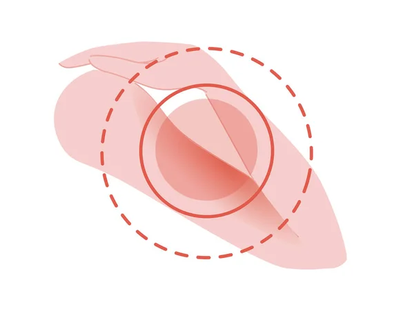 Dolor en el codo humano con dolor rojo círculo vector plano ilustración sobre fondo blanco — Vector de stock