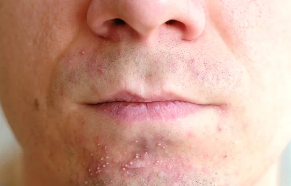 Hud irritation efter rakning på mans hud. Närbild näsa och läppar. — Stockfoto