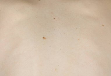 Kadının cilt mol ile arkada beyaz. Görünümü üst. Sağdan sola doğru kamera hareketi. Geri çekil kapatın.