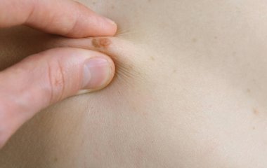 El dokunur köstebek womans cilt üzerinde mans. Doktor tıbbi tarama. El ve köstebek kadar yakın.