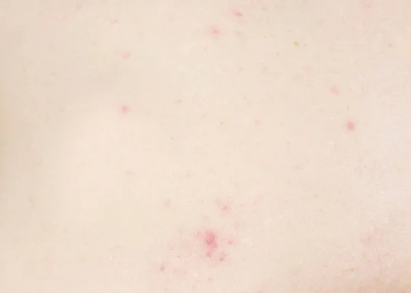 Espinhas brancas e vermelhas e acne nas costas dos homens . — Fotografia de Stock