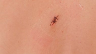 Arka dikişli yara. Mol, cerrahi çıkarıldıktan sonra iki dikiş.