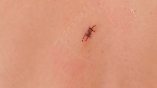 Herida cosida en la espalda. Dos suturas después de la extracción de lunares, cirugía . — Vídeos de Stock