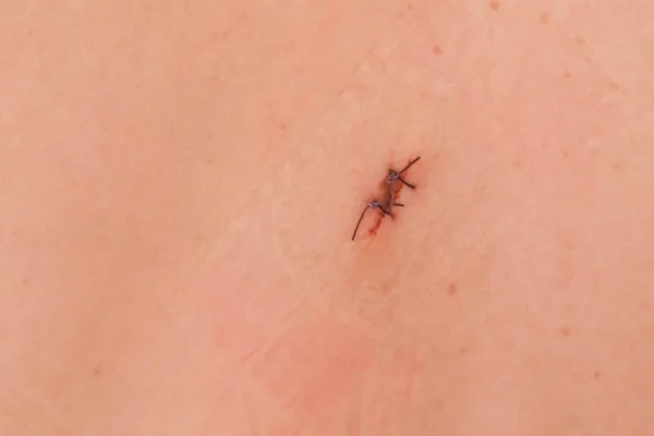 Herida cosida en la espalda. Dos suturas después de la extracción de lunares, cirugía . — Foto de Stock