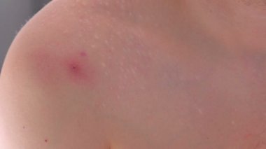 Büyük kırmızı sivilce bir omuz yakından görmek mans.