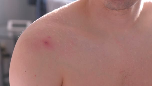 Big red pimple on a mans shoulder close-up view. — Stock Video