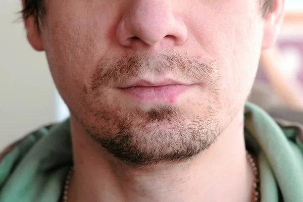 Herpes. Lip treatment. Close-up of the mans lips with herpes. Front view.