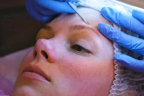 Limpieza mecánica de la cara en el esteticista. Cosmetólogo apretar el acné en la frente del paciente con aguja médica. Primer plano de la cara . — Foto de Stock