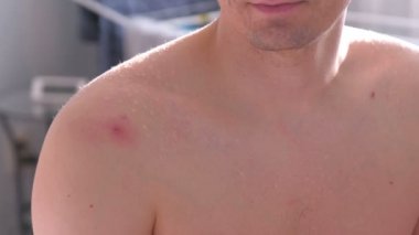 Büyük kırmızı sivilce bir omuz yakından görmek mans.