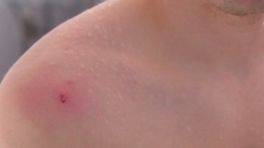 Büyük kırmızı sivilce bir omuz yakından görmek mans. Adam bir sivilce kan ile el ile sıkar.